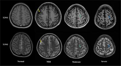 Association between abnormal plasma metabolism and brain atrophy in alcohol-dependent patients